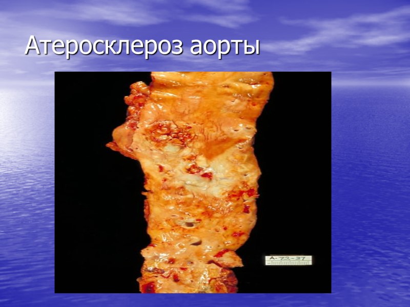 Атеросклероз аорты